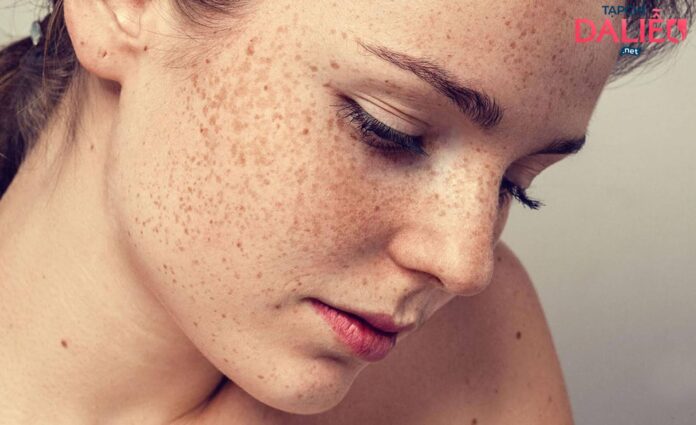 Các loại nám thường gặp: nám da do rối loạn nội tiết tố với nám da thông thường